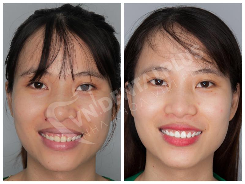 Phẫu thuật kéo dài thân răng bằng máy Laser tại Nha Khoa Việt Plus