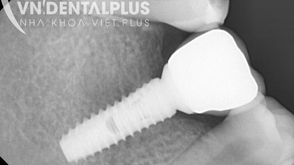 Kiểm tra sau khi gắn phục hình toàn sứ trên Implant cho khách hàng