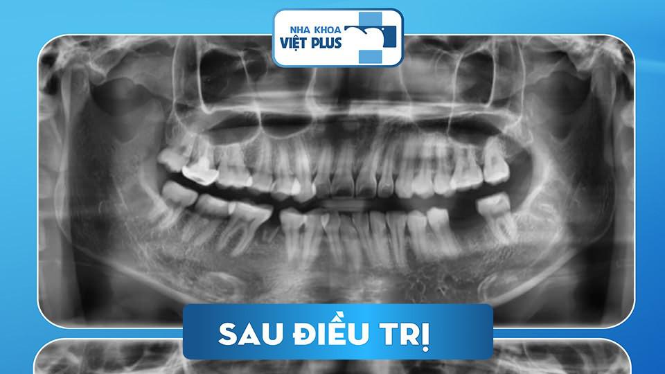 Niềng Răng Kết Hợp Cấy Ghép Implant - Giải Pháp Hoàn Hảo Cho Nụ Cười Đẹp
