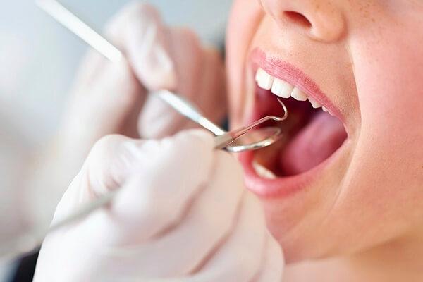 Có nên lấy cao răng không và lấy như thế nào?
