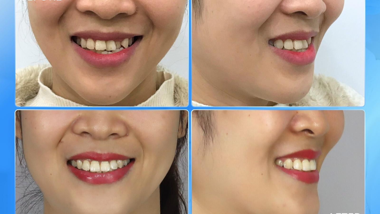 Thay đổi nụ cười – Thay đổi gương mặt!