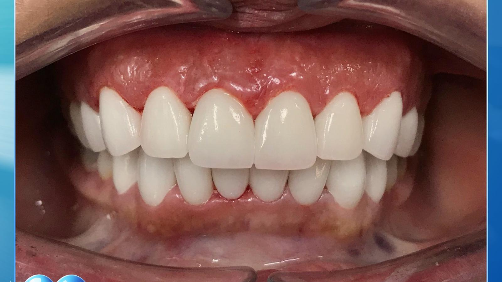 Nụ cười mới – Cuộc sống mới: Thay đổi sau một ca phục hình sứ thẩm mỹ