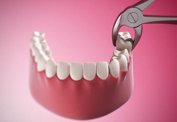 Nhổ răng khôn có nguy hiểm không và có thể gặp những biến chứng nào?