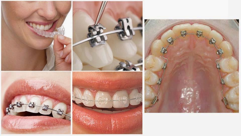 Niềng răng giá rẻ đảm bảo chất lượng và hiệu quả tại Thanh Hóa