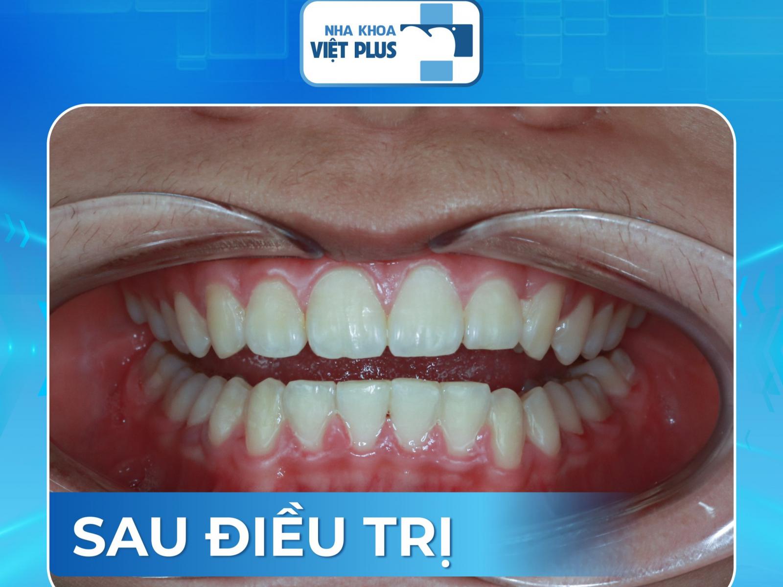 Niềng Răng 1 Hàm Có Được Không?