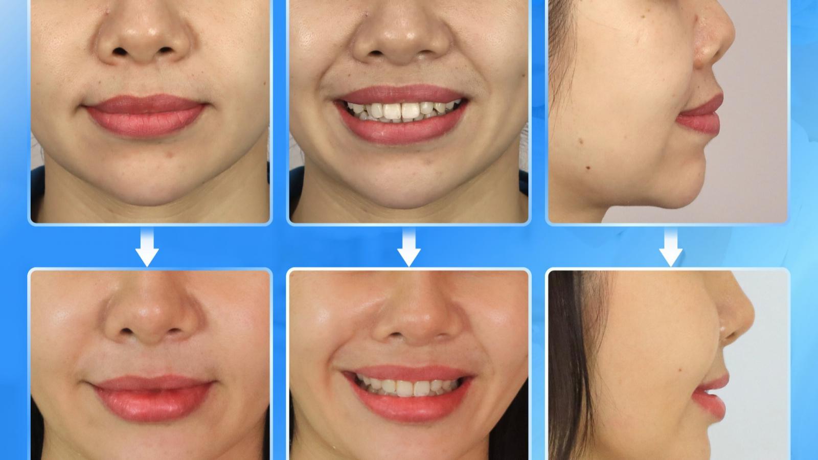 Niềng Răng Giảm Hô – Răng Đều Đẹp, Giữ Nguyên Răng Sứ