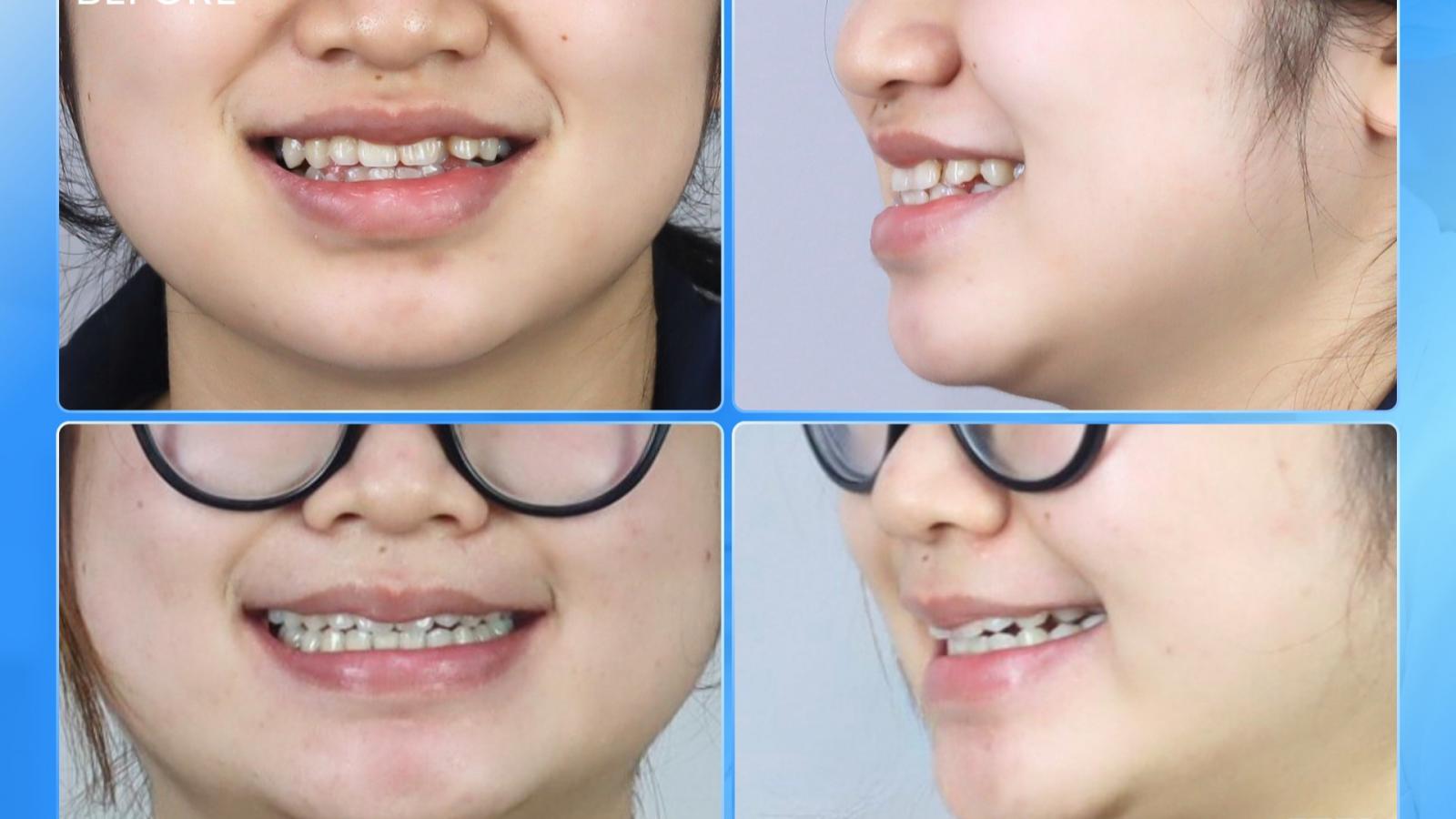 Case Niềng Răng Mắc Cài – Giải Quyết Răng Chen Chúc & Sâu Răng
