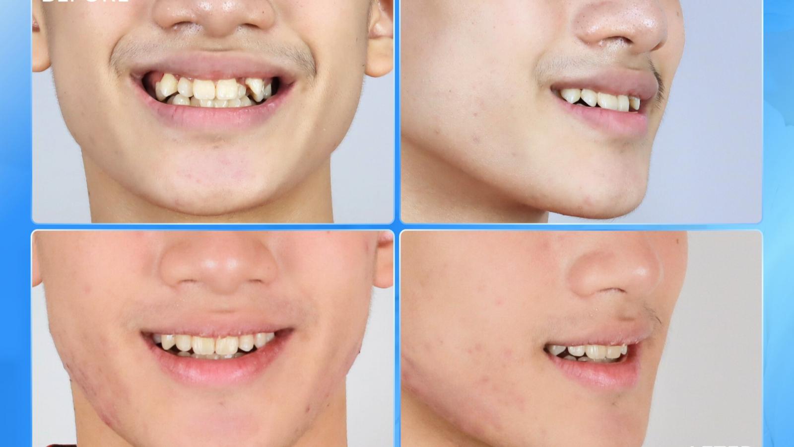 Niềng răng mắc cài – Hết chen chúc, tự tin cười đẹp ở tuổi 17