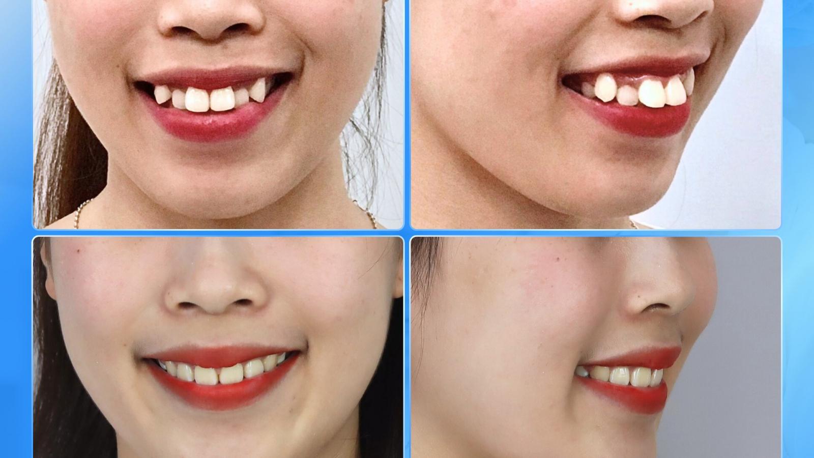 Từ răng lệch lạc, hơi hô – đến nụ cười rạng rỡ