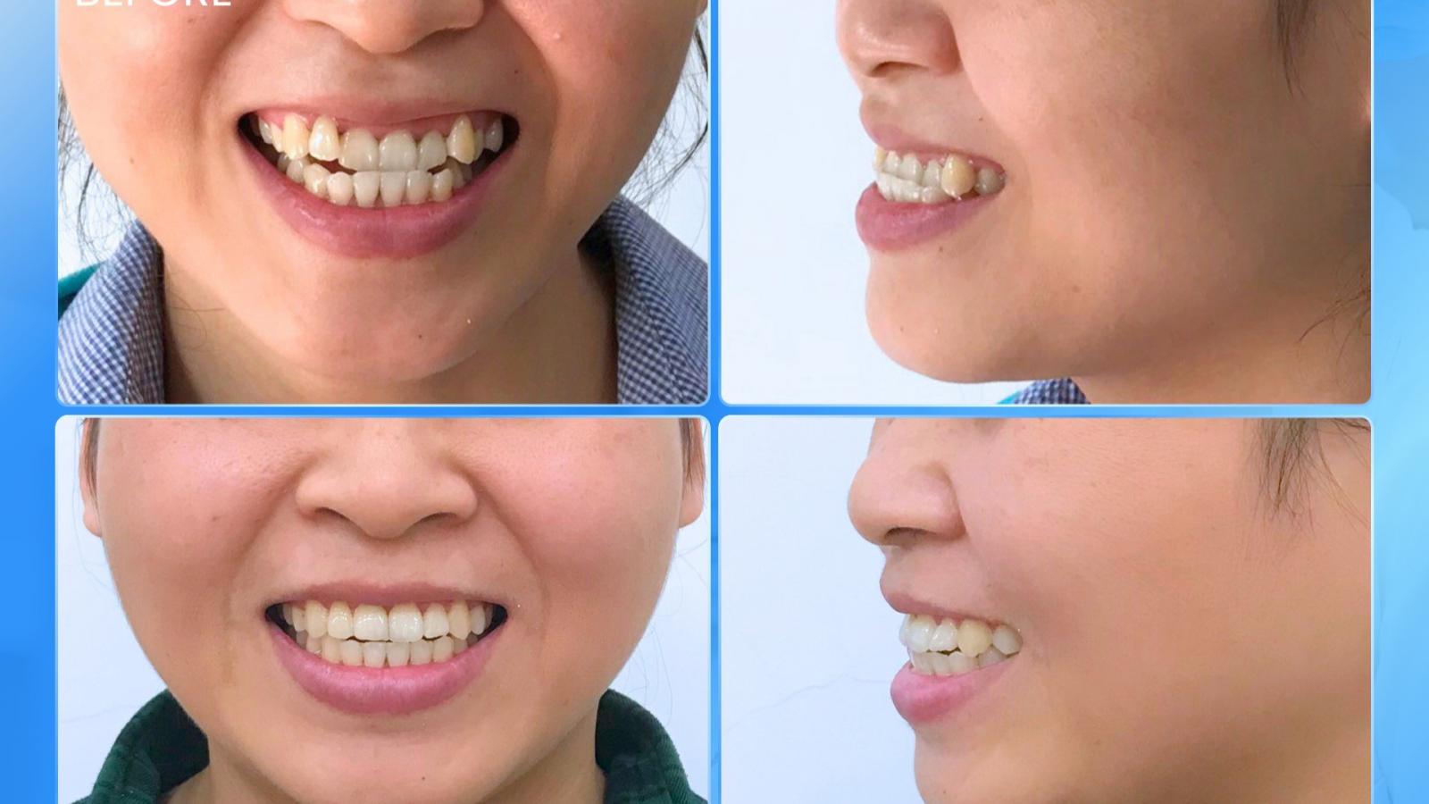 Niềng răng tuổi 33 – Để nụ cười không còn khiến mình e ngại