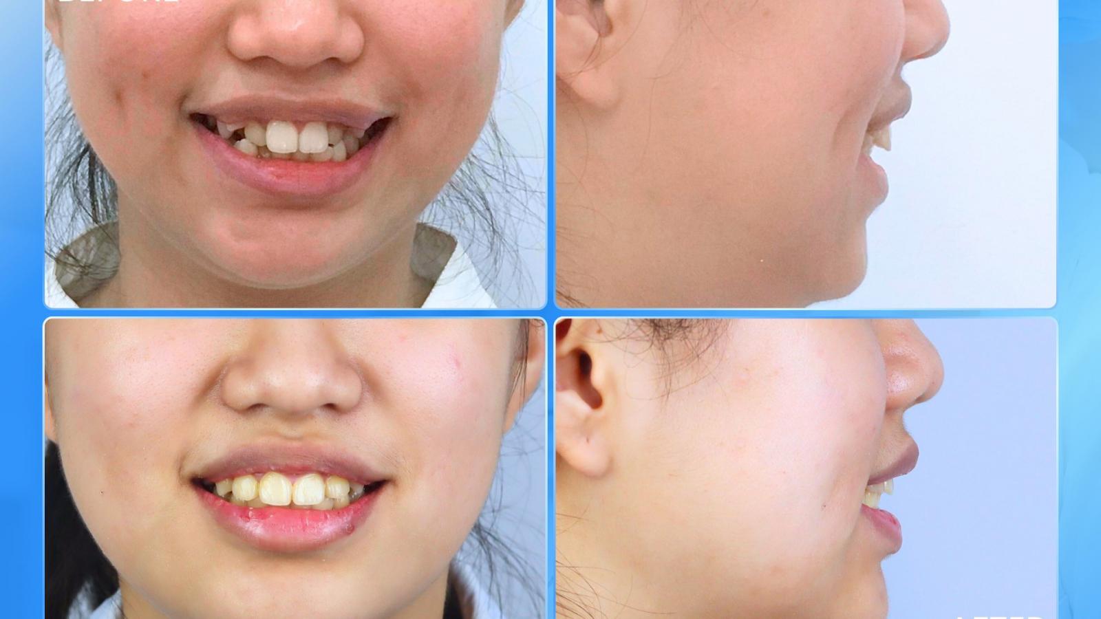 Niềng Răng Sớm – Tự Tin Trọn Đời