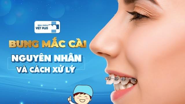 Mắc cài niềng răng bỗng “đòi tự do” và bung ra ngoài? Đừng hoảng!