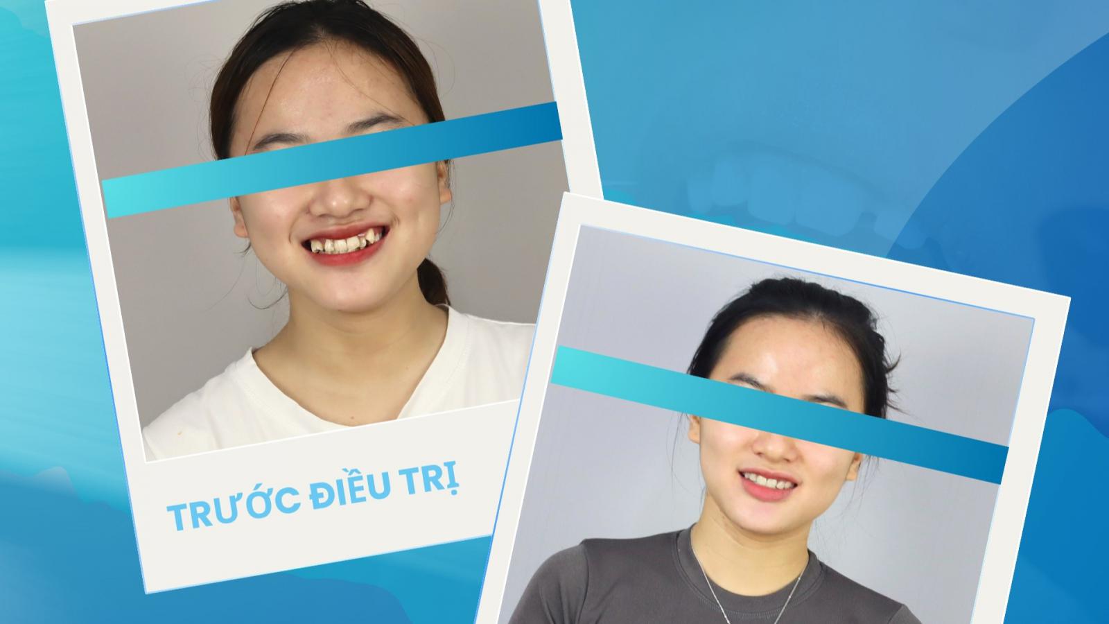 HOÀN THÀNH CA NIỀNG RĂNG CHEN CHÚC TRẦM TRỌNG