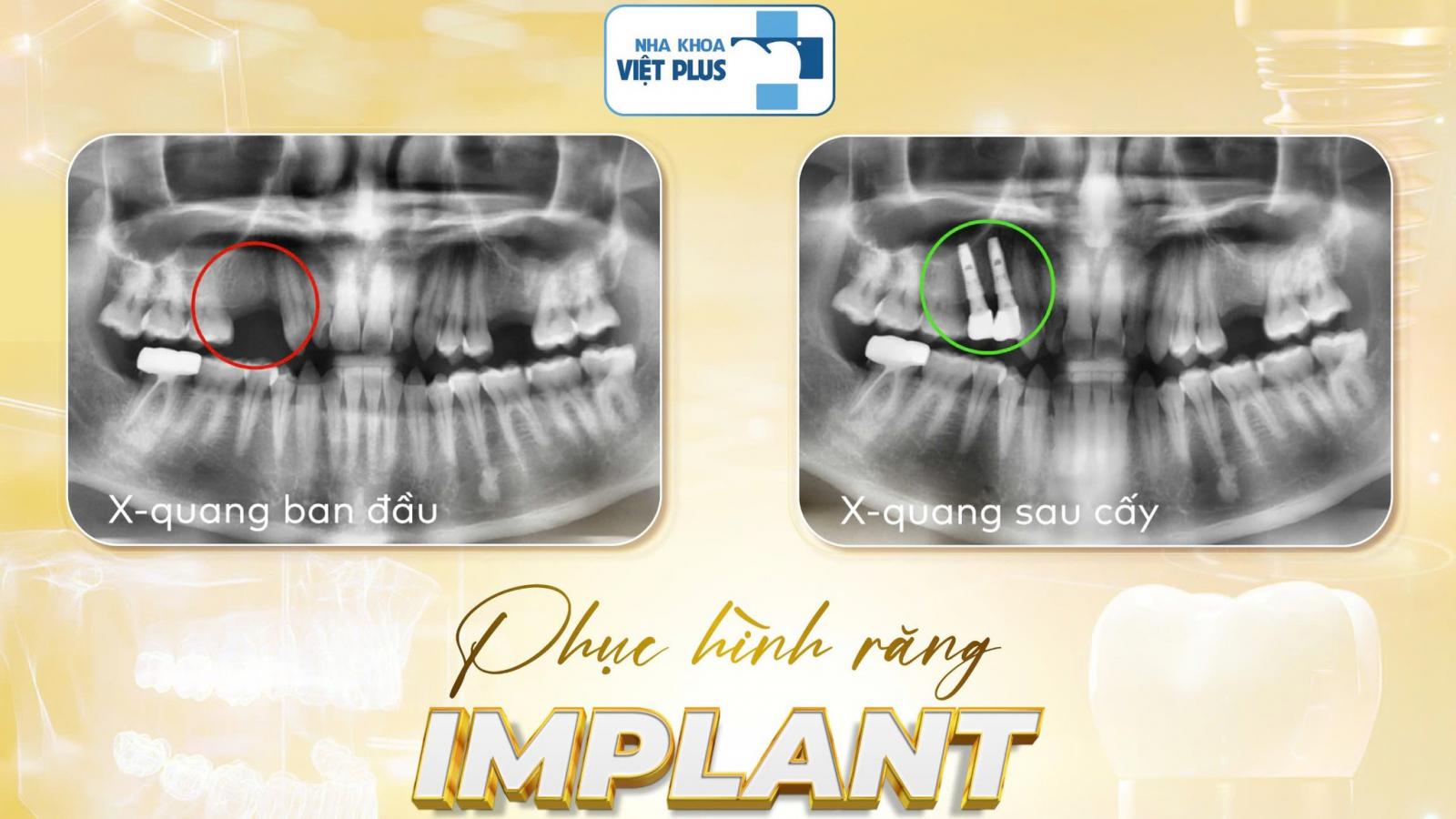 PHỤC HÌNH RĂNG IMPLANT – GIẢI PHÁP HOÀN HẢO CHO NỤ CƯỜI VÀ CHỨC NĂNG ĂN NHAI