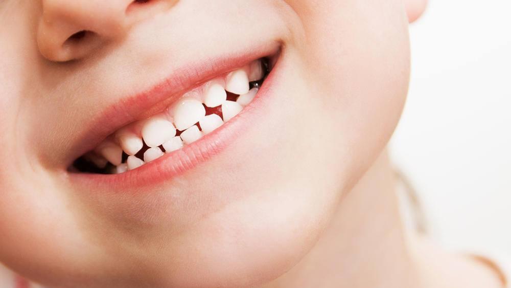 SÂU RĂNG SỮA Ở TRẺ EM