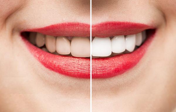 Tẩy trắng răng có hại gì không đến sức khỏe con người?