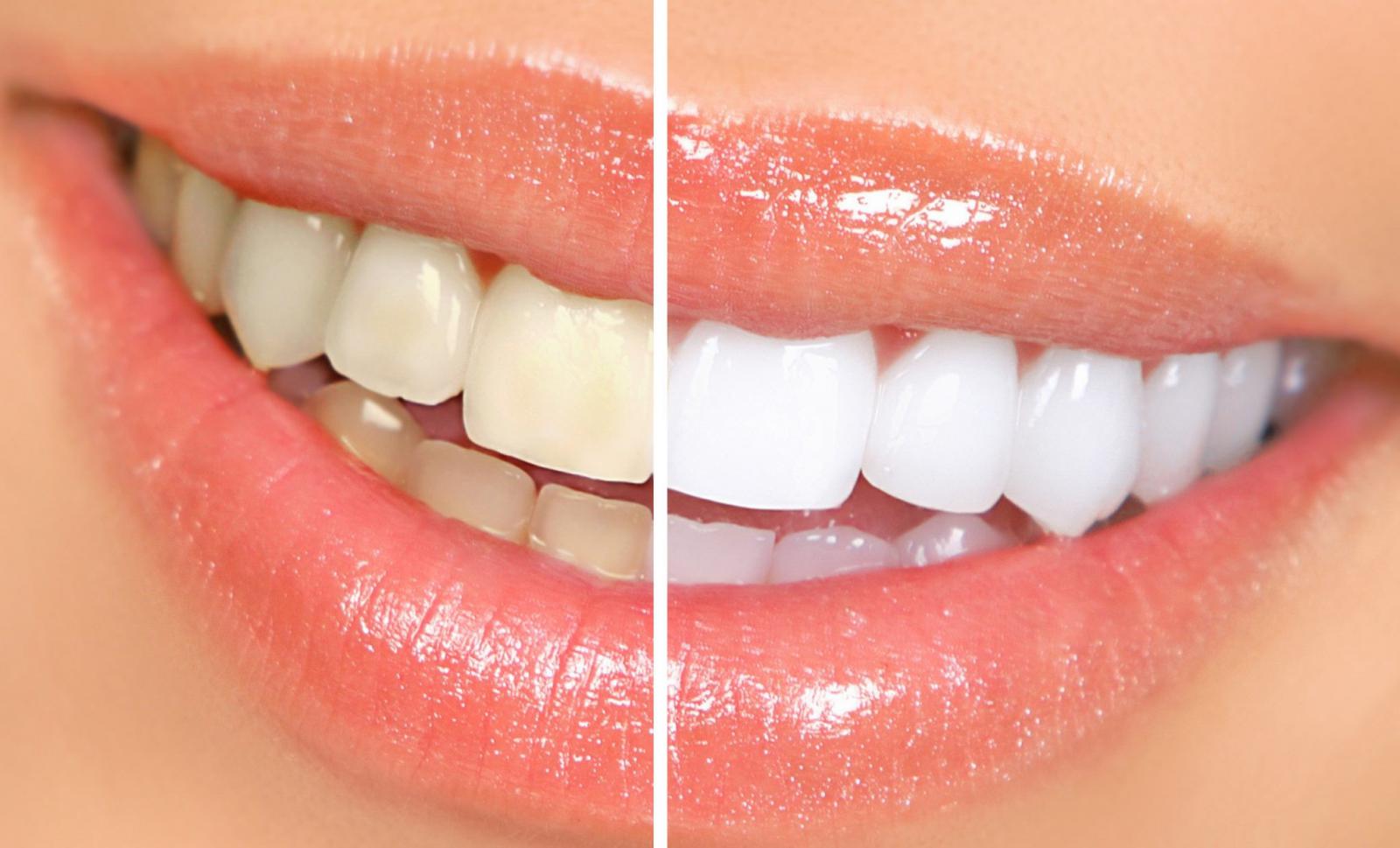 Tẩy trắng răng ở đâu uy tín đảm bảo an toàn và hiệu quả cao?