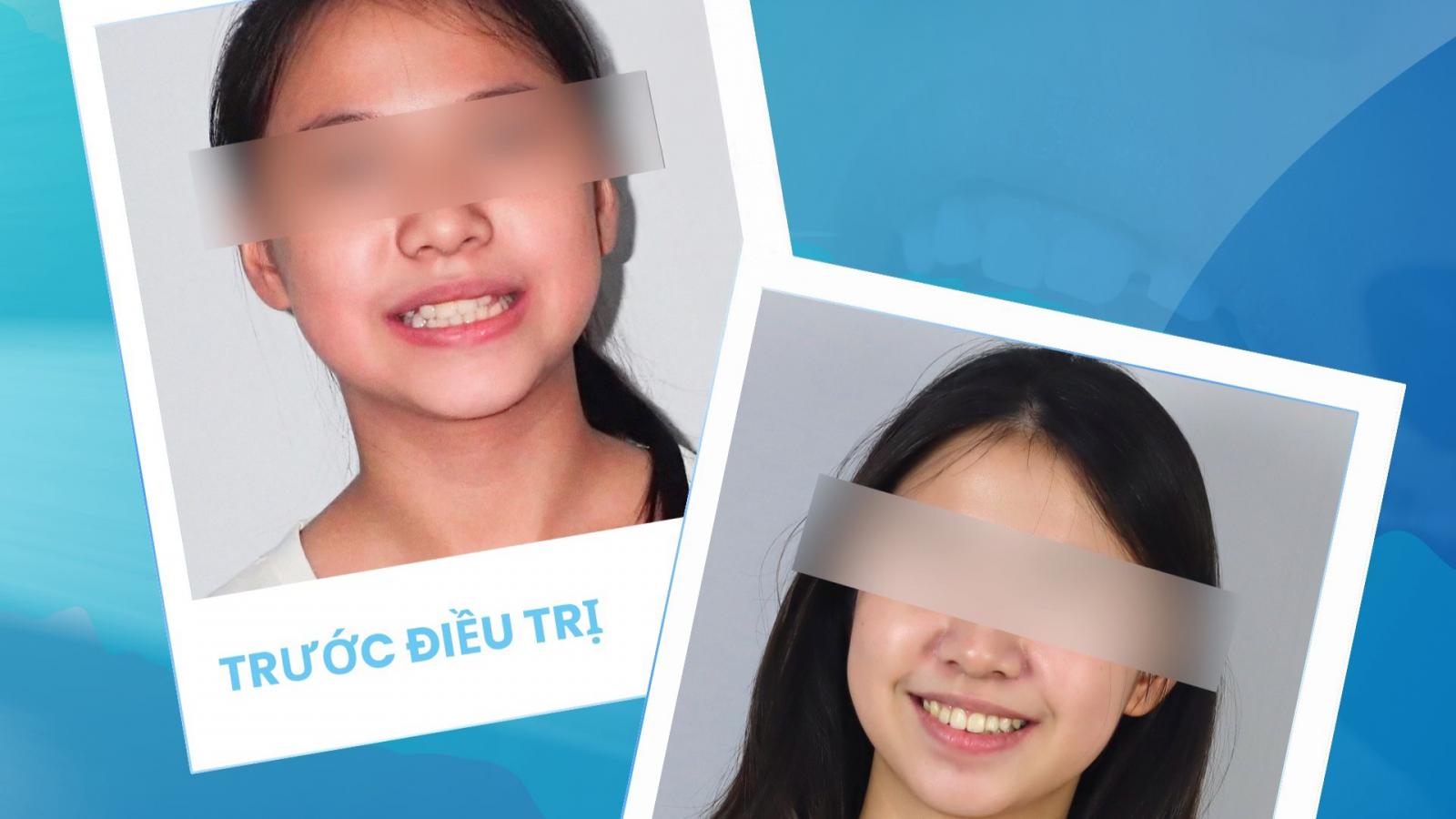 Hoàn tất ca niềng răng trẻ em – Nụ cười đều đẹp, khớp cắn chuẩn chức năng