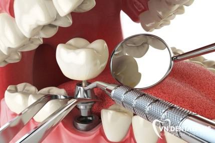 Trồng răng implant là gì và tại sao nên trồng răng implant?