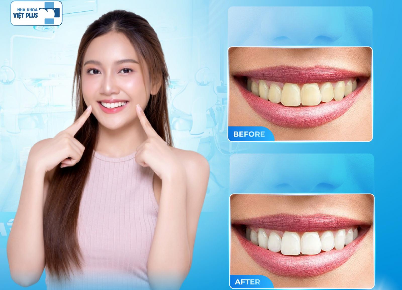 CHỈ 60 PHÚT TẨY TRẮNG RĂNG THAY ĐỔI NỤ CƯỜI - NÓI KHÔNG VỚI Ố - VÀNG - XỈN - ĐEN