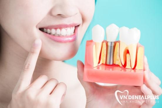 Quy trình cấy ghép răng implant được thực hiện như thế nào?