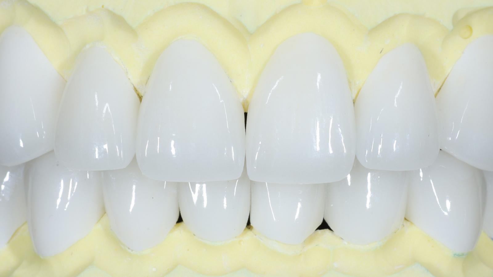 Hoàn tất COMBO 22 RĂNG SỨ V+ SMILE