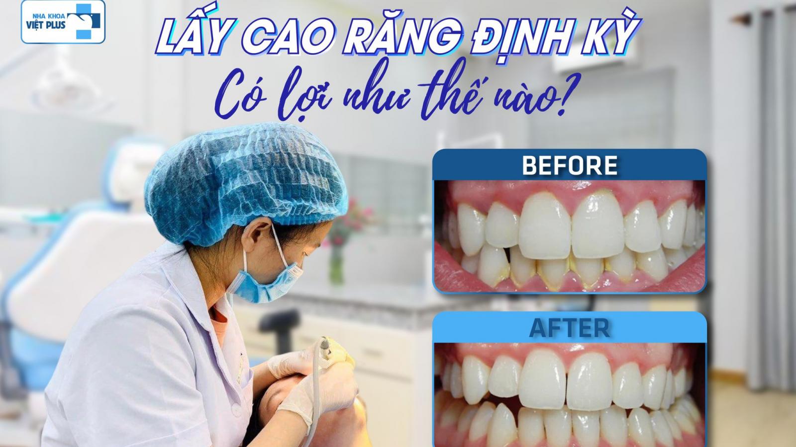CAO RĂNG, MẢNG BÁM - KẺ THÙ CỦA HÀM RĂNG KHOẺ