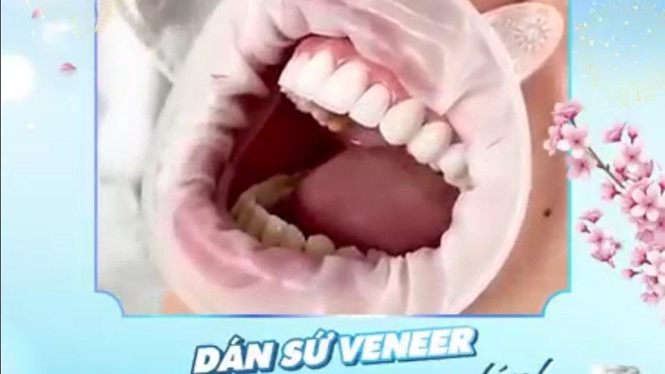 VÌ SAO DÁN SỨ VENEER LẠI KHIẾN KHÁCH HÀNG NHA KHOA VIỆT PLUS MÊ MẨN ĐẾN VẬY?