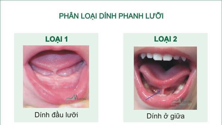 Dính thắng lưỡi - nguyên nhân gây ảnh hưởng đến sự phát âm ở trẻ