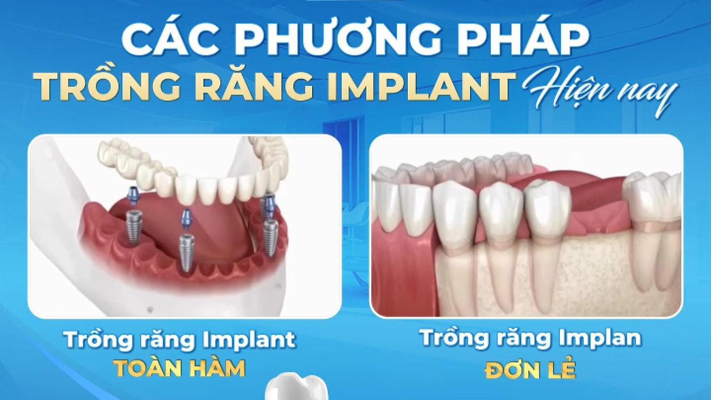 CÁC PHƯƠNG PHÁP TRỒNG RĂNG IMPLANT HIỆN NAY