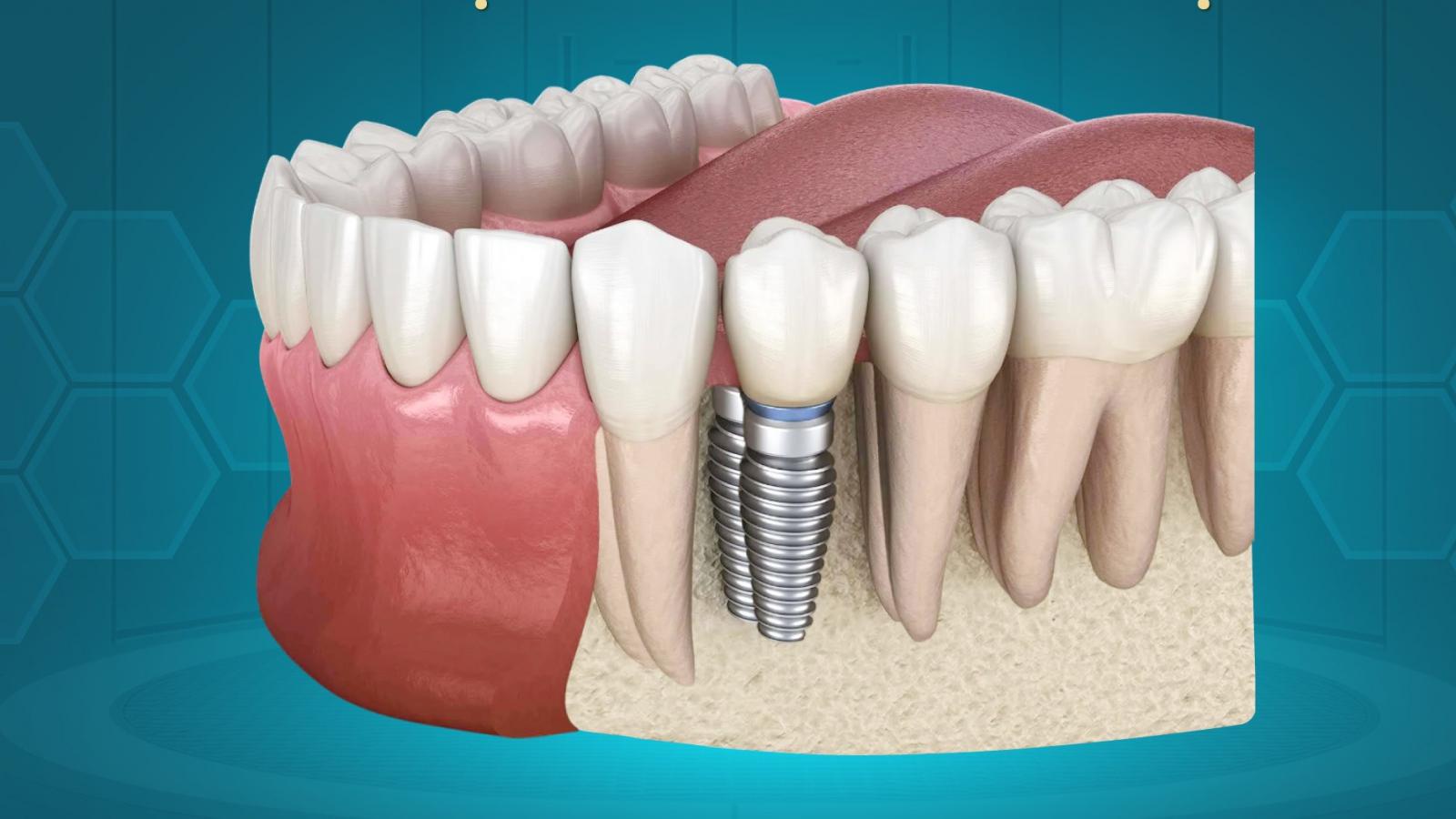 CẤY GHÉP IMPLANT - GIẢI PHÁP HIỆN ĐẠI CHO NGƯỜI MẤT RĂNG