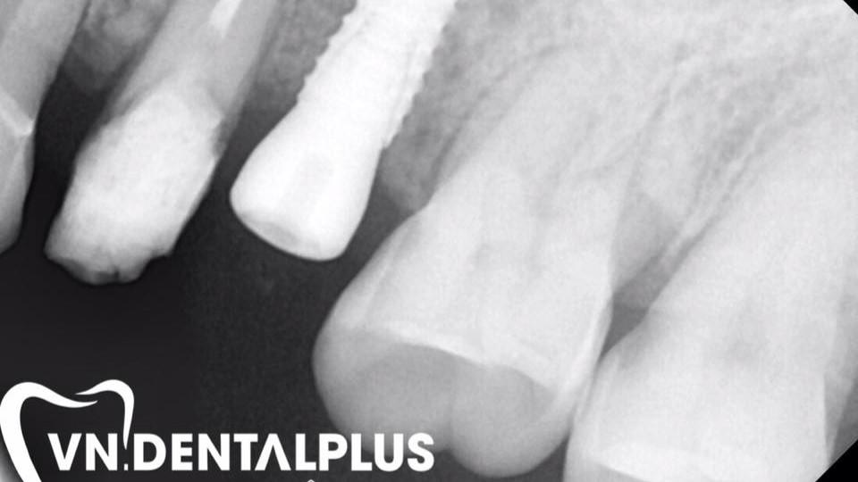 VÌ SAO KHÁCH HÀNG CHỌN CẤY GHÉP IMPLANT TẠI NHA KHOA VIỆT PLUS?