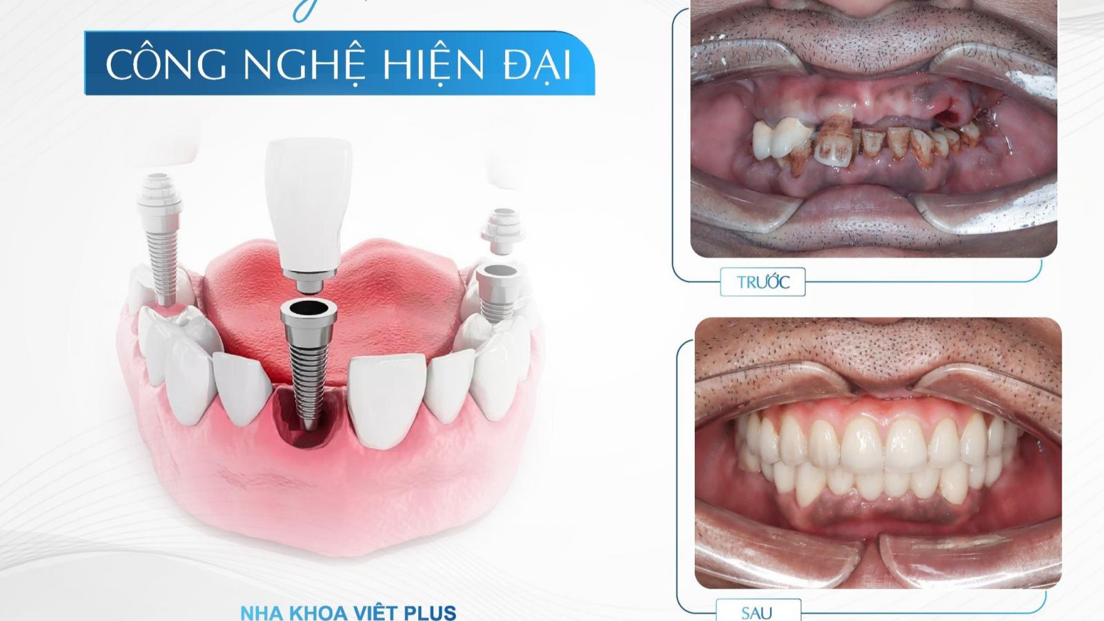 CẤY GHÉP IMPLANT VỚI CÔNG NGHỆ HIỆN ĐẠI