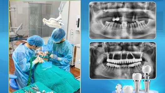 IMPLANT VỮNG CHẮC – KHÍ SẮC RẠNG NGỜI!