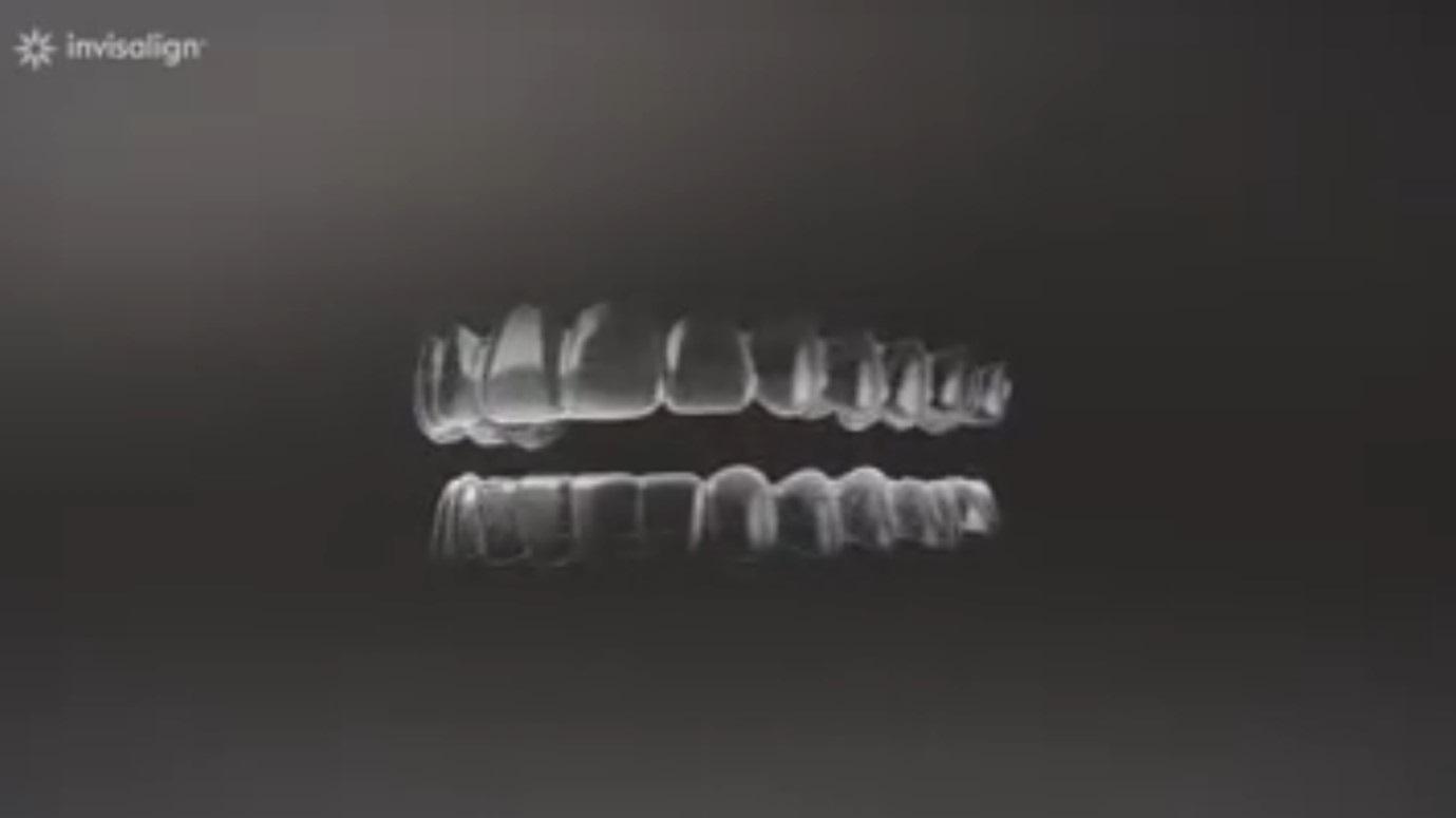 INVISALIGN - DI CHUYỂN RĂNG BẰNG MÁNG TRONG SUỐT