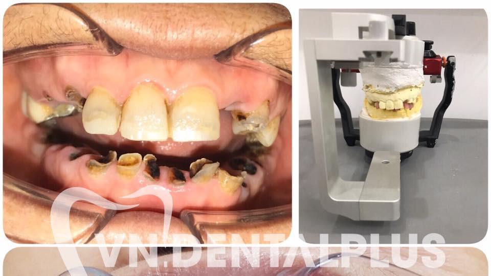 KHẮC PHỤC MÒN RĂNG – GIẢI PHÁP TOÀN DIỆN