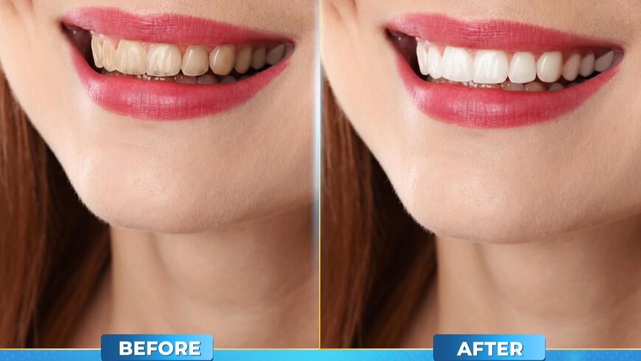 Sở hữu nụ cười rạng rỡ bắt đầu từ hàm răng trắng sáng