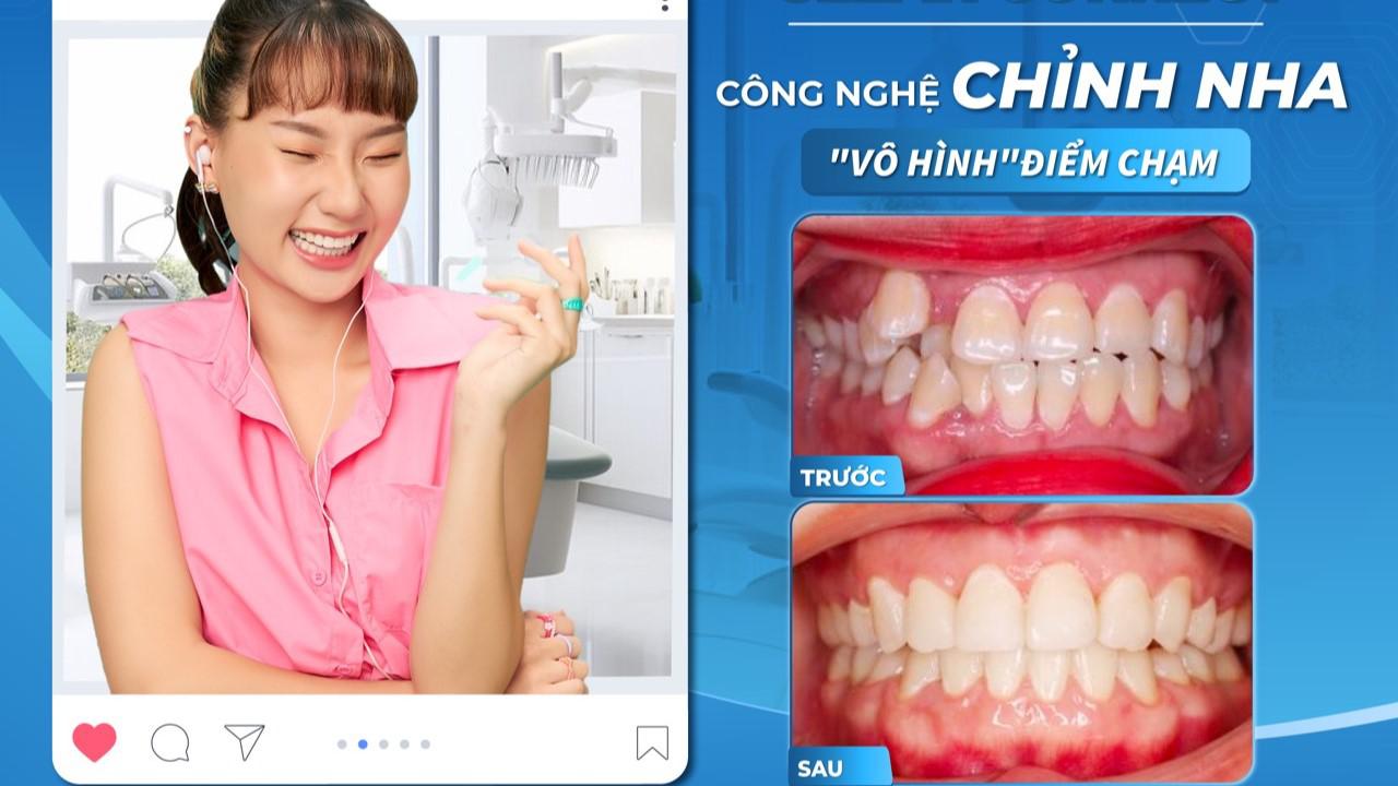 NIỀNG RĂNG CLEAR CORRECT - Công nghệ chỉnh nha
