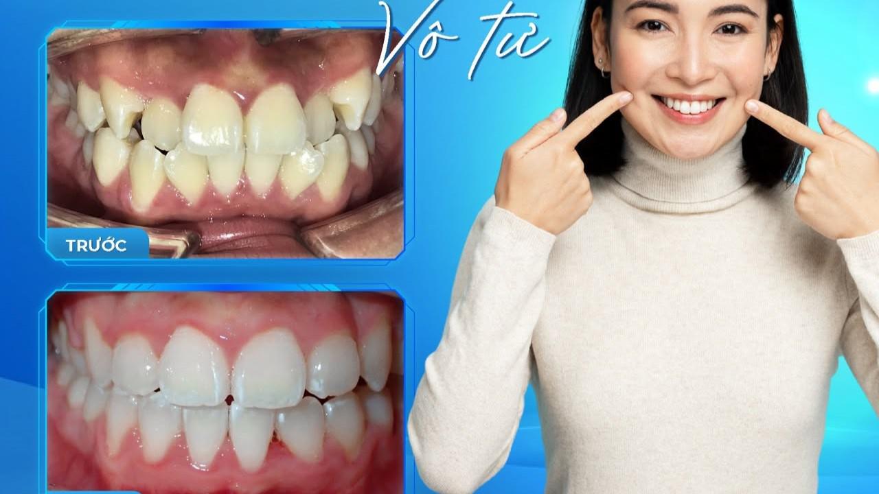 LƯƠNG 5 TRIỆU VẪN NIỀNG RĂNG VÔ TƯ