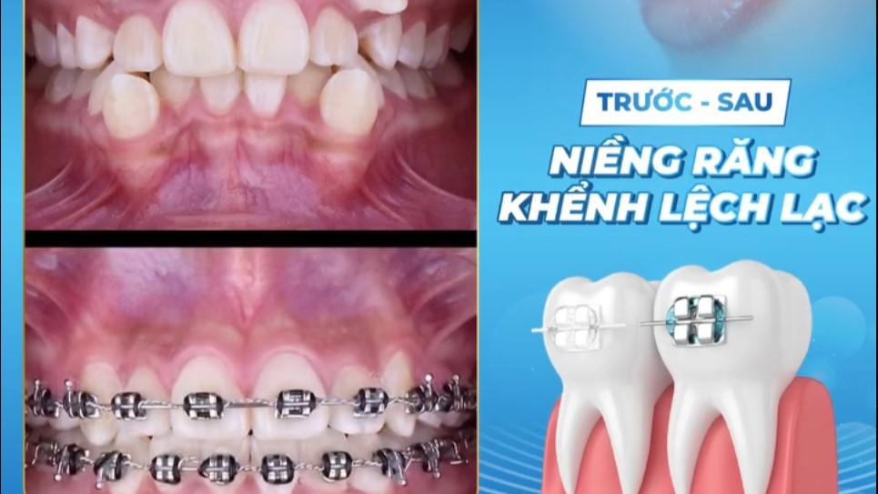 TẠM BIỆT HÀM RĂNG KHỂNH LỆCH LẠC – SỞ HỮU NỤ CƯỜI TỰ TIN SAU NIỀNG RĂNG