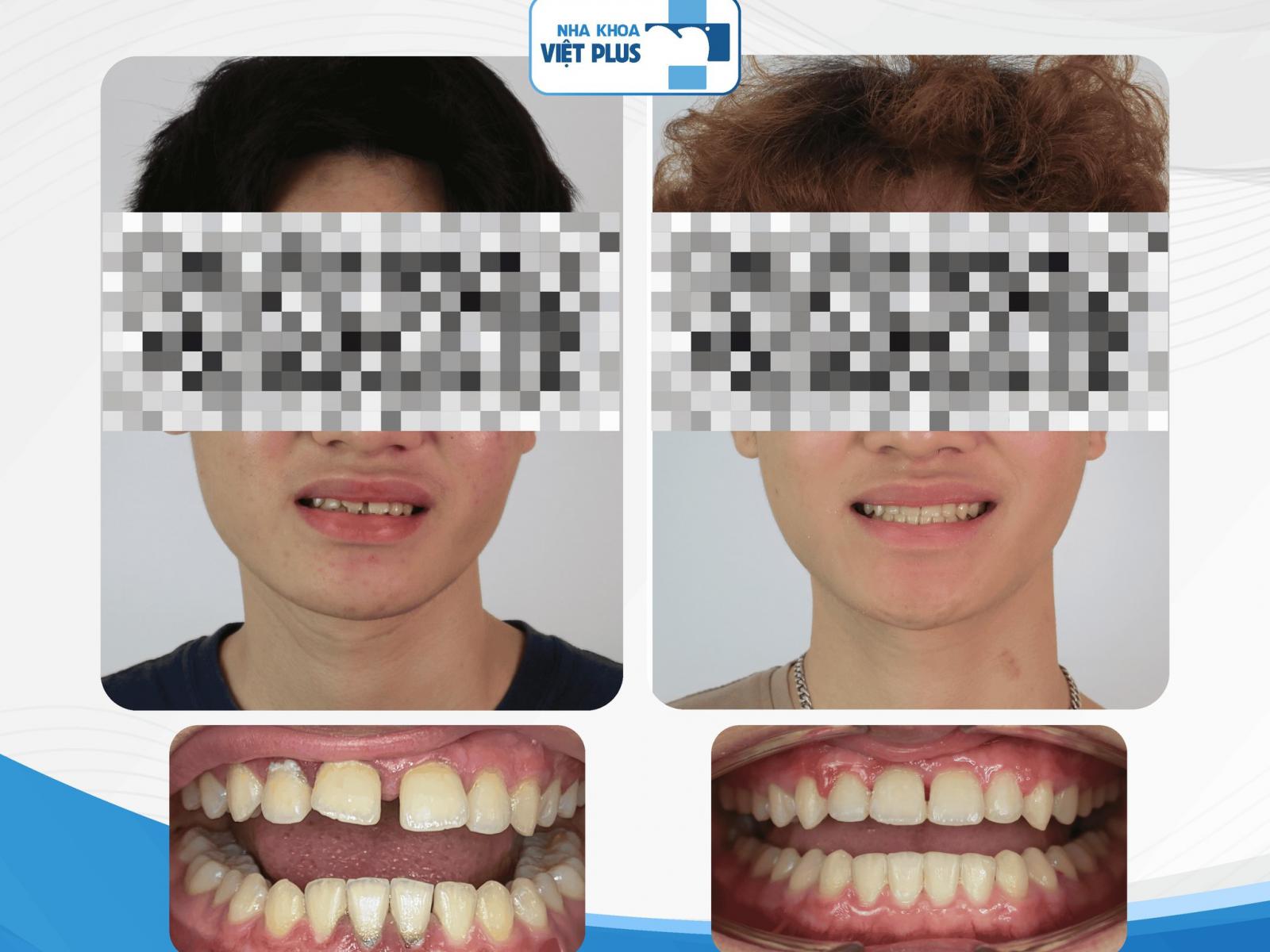 NIỀNG RĂNG – KHÔNG CHỈ LÀ sắp đều răng thẳng hàng mà còn là sự cân đối toàn diện