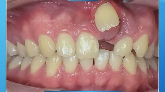 KỸ THUẬT KÉO RĂNG TRONG CHỈNH NHA – GIẢI PHÁP CHO NỤ CƯỜI CÂN ĐỐI, HÀI HÒA