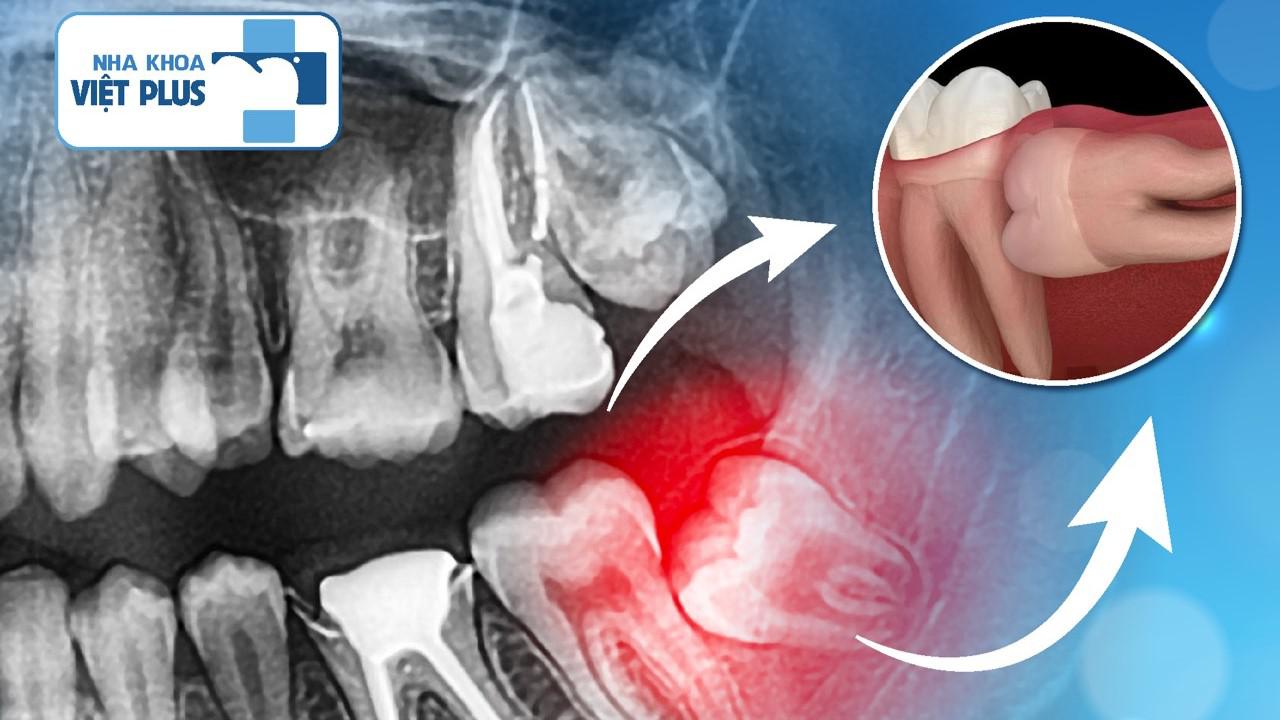 Liệu có nên xóa sổ răng khôn mọc ngầm?