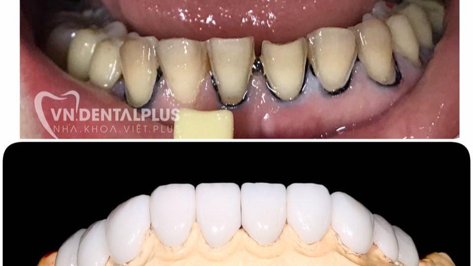 VENEER SỨ THỦY TINH – GIẢI PHÁP TÁI TẠO NỤ CƯỜI