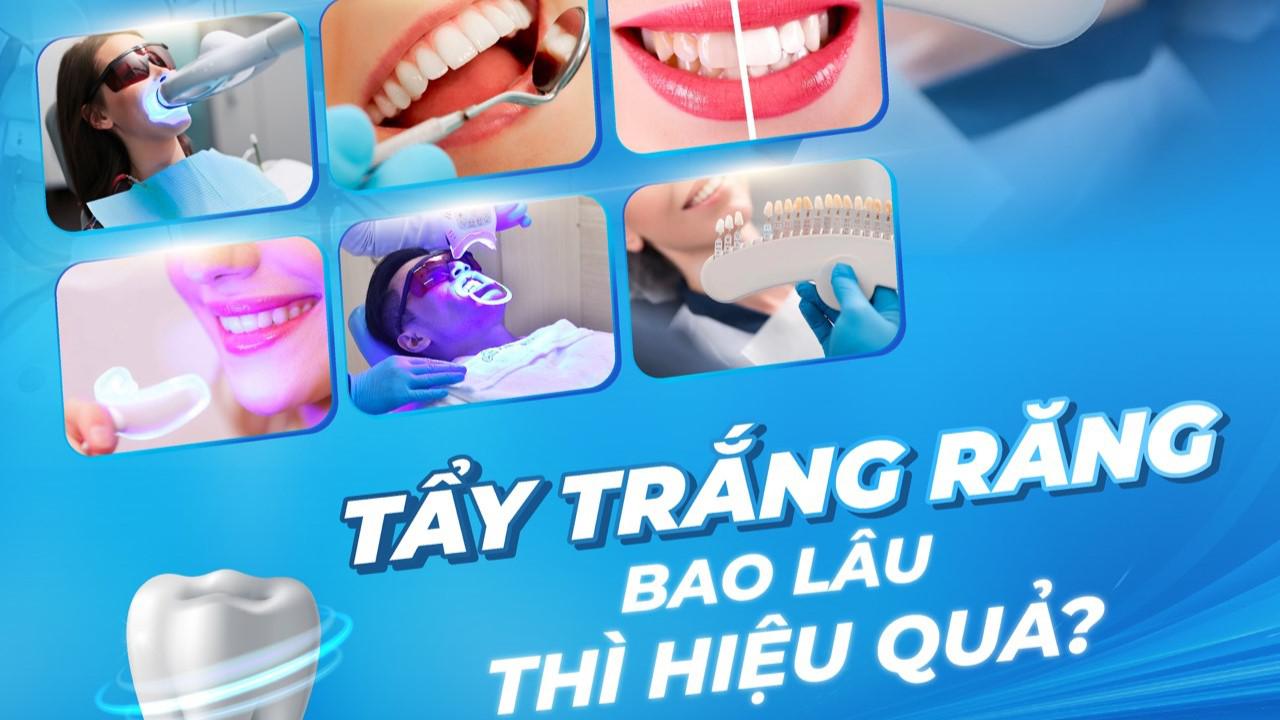 Tẩy trắng răng bao lâu thì hiệu quả?