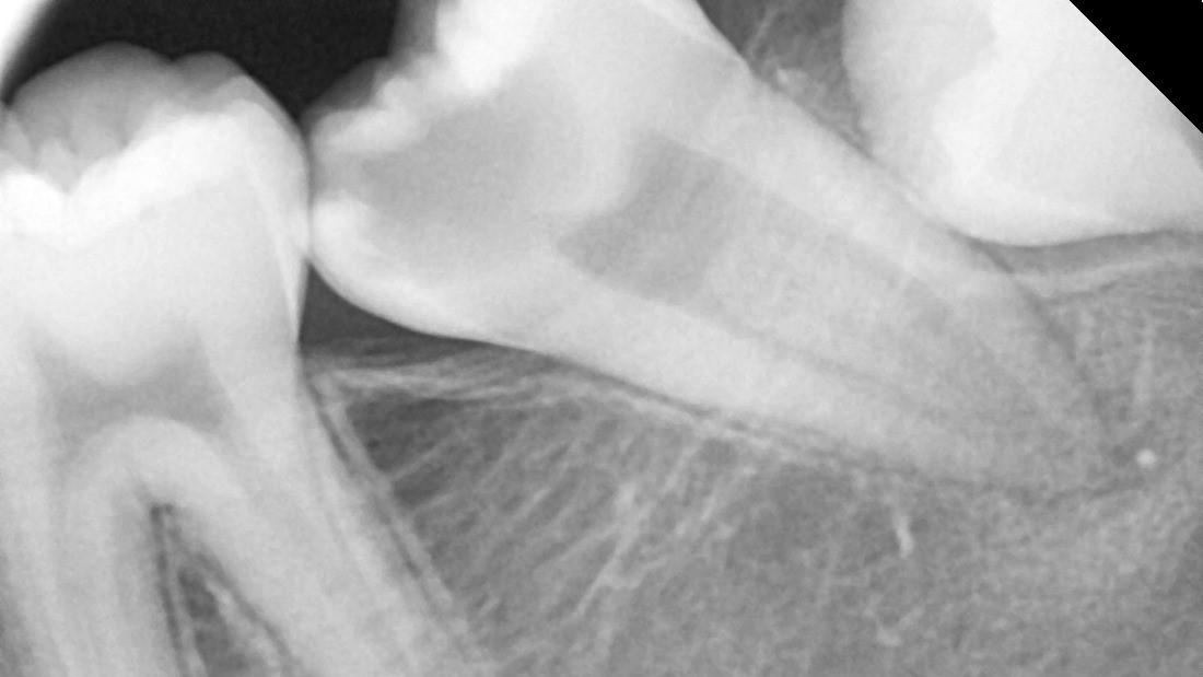 ĐIỀU TRỊ TỦY RĂNG HÀM LỚN